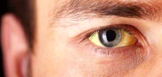 لکه‌های زرد چشم نشانه ابتلا به این بیماری خطرناک است