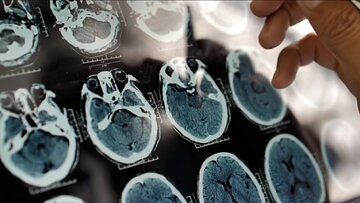 5 علامت هشدار دهنده که خبر از پیری زودرس مغز می دهد