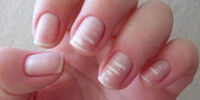 کرونا عامل لکه‌های سفیدرنگ روی ناخن!