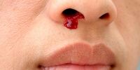 شایع‌ترین علل خونریزی بینی؛ چه زمانی به پزشک مراجعه کنیم؟