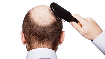 با مصرف این ریزمغذی‌های مفید، ریزش مو را ضربه فنی کنید