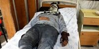 مصدومیت نوجوان 17 ساله در پی انفجار نارنجک دست‌ساز