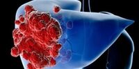 علائم سرطان کبد چیست؟
