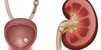 یک توصیه مهم برای افراد مبتلا به سنگ کلیه