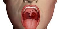 این علائم خطرناک در دهان نشانه ابتلا به سرطان است 