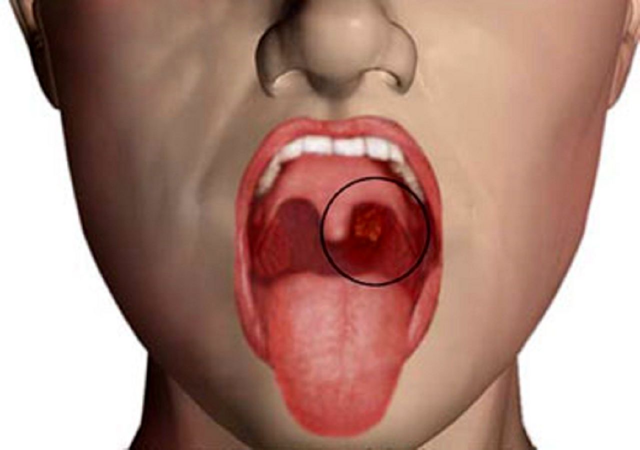 این علائم خطرناک در دهان نشانه ابتلا به سرطان است 