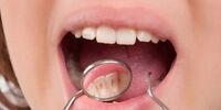 چرا وضعیت پوسیدگی دندان محصلان مدارس خصوصی بدتر است؟