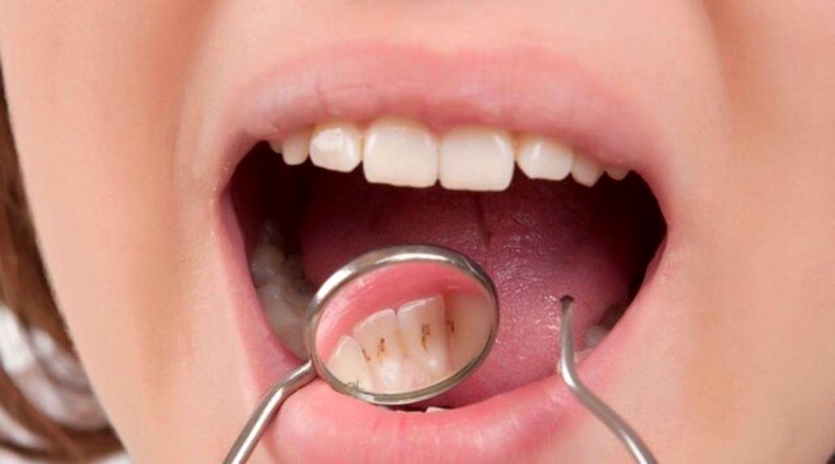 چرا وضعیت پوسیدگی دندان محصلان مدارس خصوصی بدتر است؟