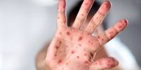 آبله میمون از چه راهی منتقل می شود؟