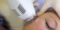 سوالات رایج هایفوتراپی صورت: آنچه در مورد هایفوتراپی باید بدانیم