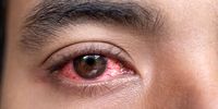دلیل بیماری قرمزی چشم؛ هزاران نفر در این کشور مبتلا شدند