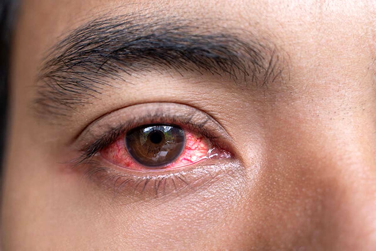 دلیل بیماری قرمزی چشم؛ هزاران نفر در این کشور مبتلا شدند