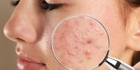 نتایج  غافلگیرکننده یک پژوهش؛ آکنه برای پوست مفید است!