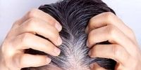 یافتهای جدید درباره سفید شدن مو / پای یکی از خطرناکترین سرطانهای پوستی در میان است