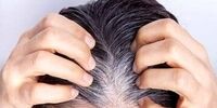 یافته‌ای جدید درباره سفید شدن مو / پای یکی از خطرناک‌ترین سرطان‌های پوستی در میان است