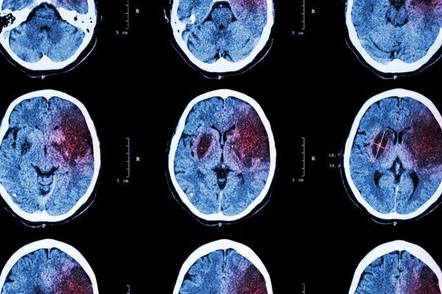 با چه روش هایی از سکته مغزی جلوگیری کنیم؟