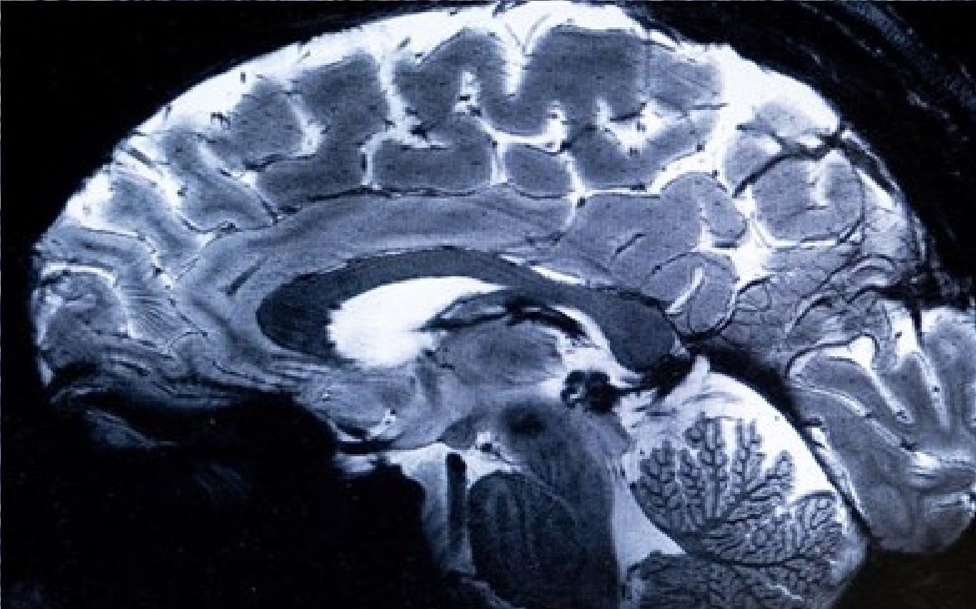 اسکن تصاویر مغز انسان توسط قدرتمندترین "ام‌ آر آی" جهان 