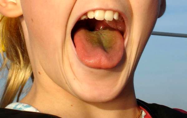 زردی زبان نشانه کدام بیماری است
