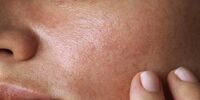 کسانی که پوست چرب دارند این توصیه ها را جدی بگیرند