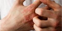 درمان خشکی پوست ناشی از مصرف موادشوینده / مصرف بیش از اندازه گرمی ممنوع