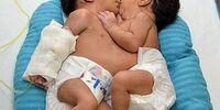 تصاویری از جداسازی دوقلوهای بهم چسبیده اهوازی/جزئیات جدید از وضعیت جسمانی نوزادان+ عکس
