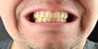 این عادت‌های غلط دندان‌های شما را زرد می‌کنند
