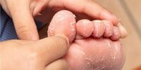 این نشانه ها در پوست یعنی بیماری پوست ماهی گرفته اید 
