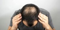 این شیرین کننده طبیعی از کچل شدن شما جلوگیری می کند

