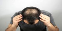 این شیرین کننده طبیعی از کچل شدن شما جلوگیری می کند