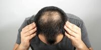 این شیرین کننده طبیعی از کچل شدن شما جلوگیری می کند
