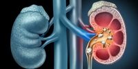 شرایط روزه‌داری در بیماران دارای سابقه سنگ کلیه