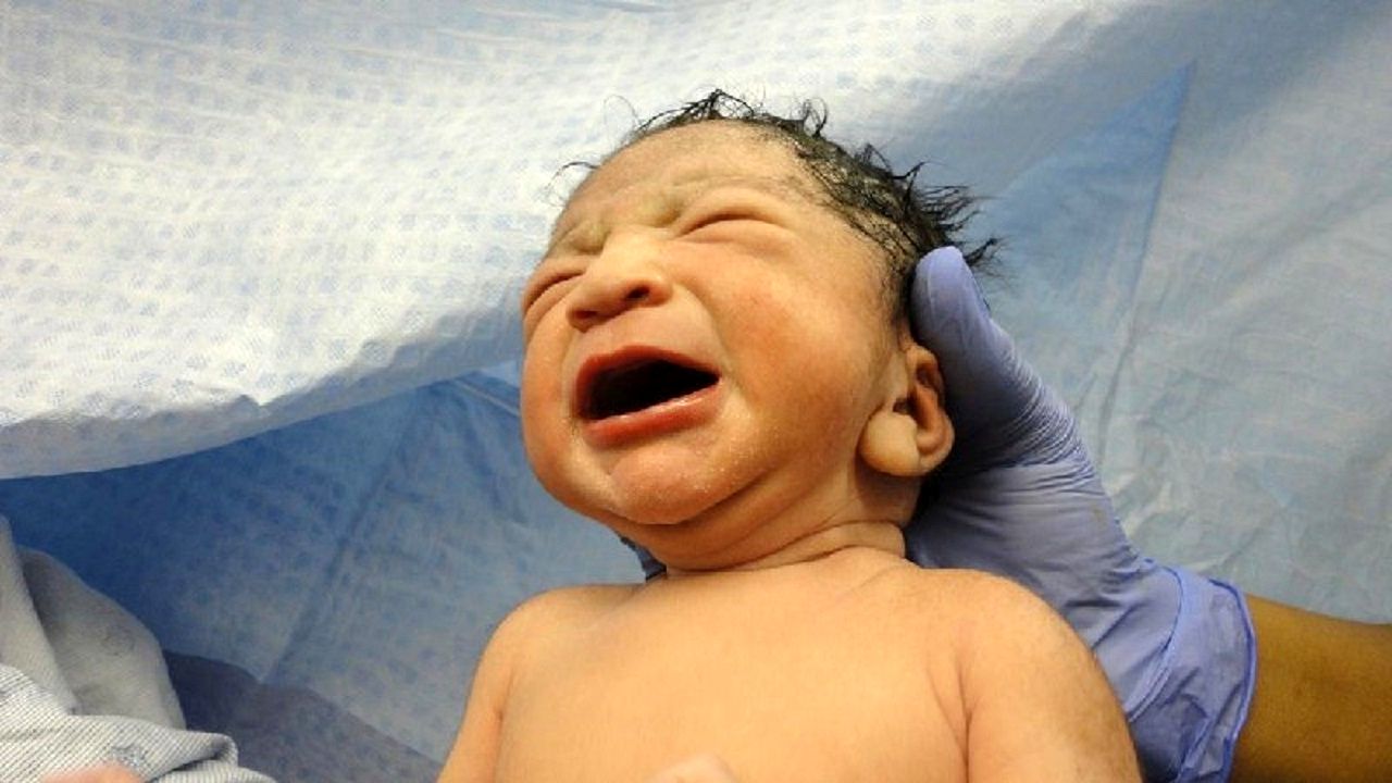 تولد نوزاد عجیب الخلقه با یک دم خبرساز شد! + عکس