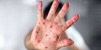 سومین فوتی ناشی از ابتلا به سرخک در آمریکا
