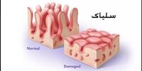 این بیماری هزارچهره را جدی بگیرید

