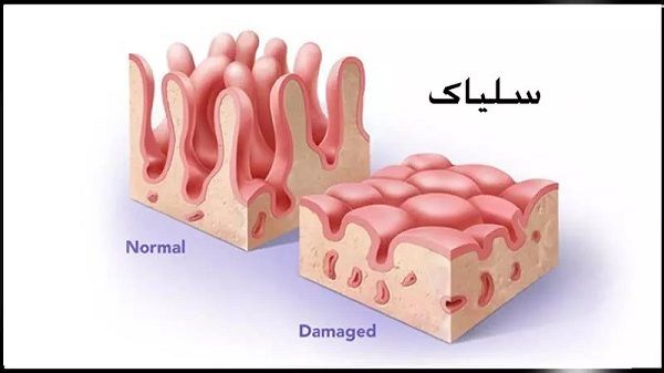 این بیماری هزارچهره را جدی بگیرید