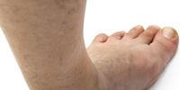 آمبولی(DVT): لخته شدن خون بعلت ارث، ایستادن و نشستن زیاد