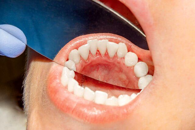 نشانه‌های شایع سرطان دهان چیست؟
