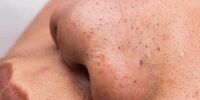 ۷ ترفند خانگی برای از بین بردن جوش‌های سرسیاه
