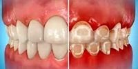 علت ایجاد لکه‌های سفید روی دندان چیست؟