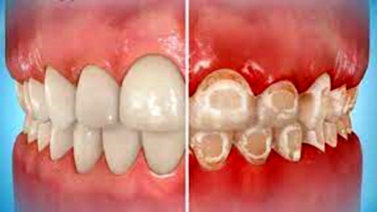 علت ایجاد لکه‌های سفید روی دندان چیست؟