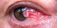 علائم ابتلا به سرطان چشم را بشناسید
