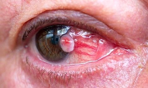 علائم ابتلا به سرطان چشم را بشناسید
