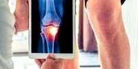 اگر به پوکی استخوان مبتلا هستید؛ حتما بخوانید!
