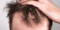 چی بخوریم تا ریزش مو نداشته باشیم؟