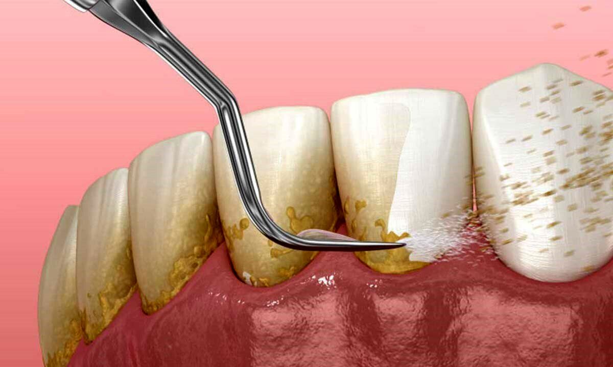 آیا جرم‌گیری باعث فاصله بین دندان‌ها می‌ شود؟