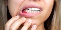 نشانه های این بیماری در دندان ظاهر می شود 