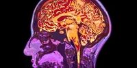 ۳ فاکتور خطرناک ابتلا به زوال عقل 
