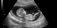 سونوگرافی از جنین؛ تجارتی پردرآمد برای پزشکان