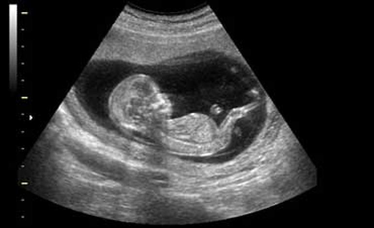 سونوگرافی از جنین؛ تجارتی پردرآمد برای پزشکان