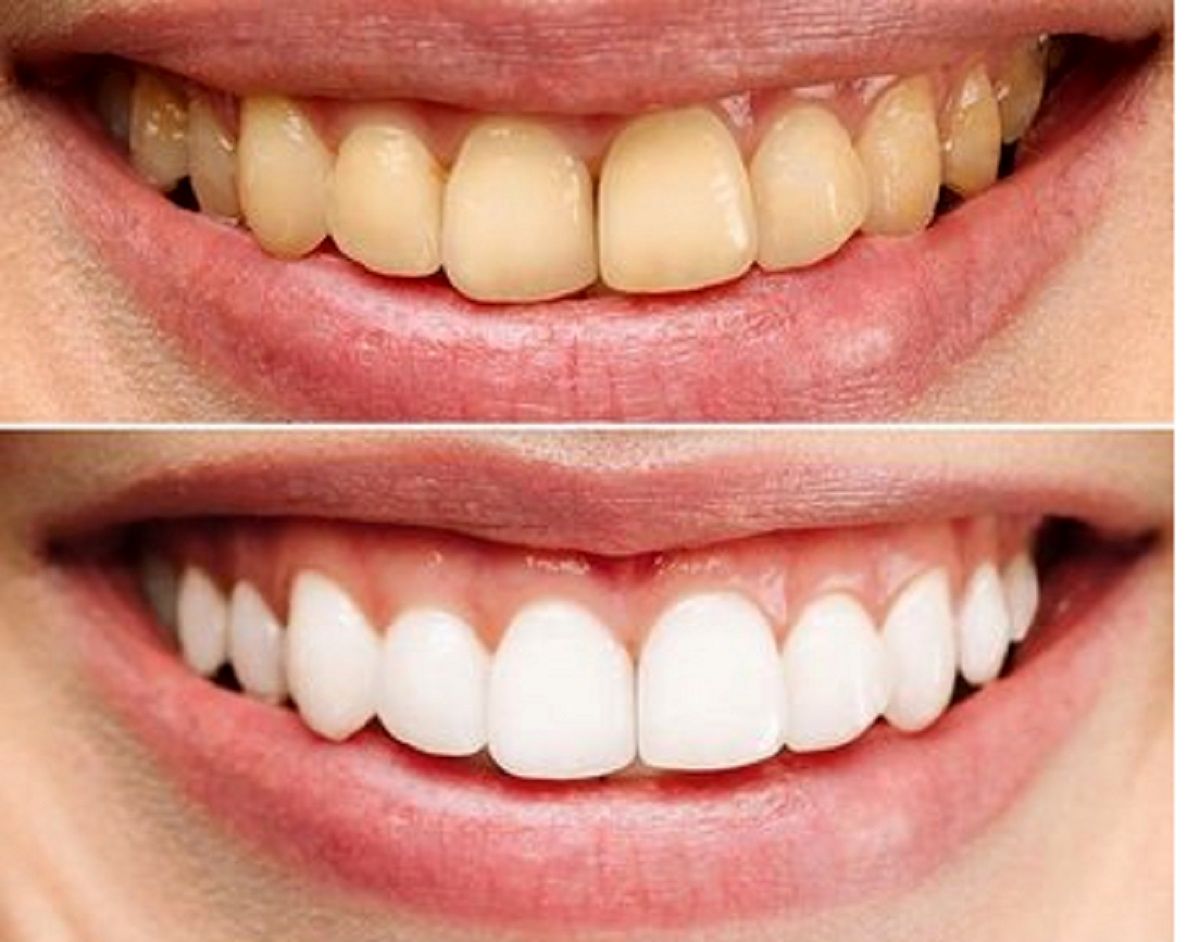 روش درست استفاده از نخ دندان